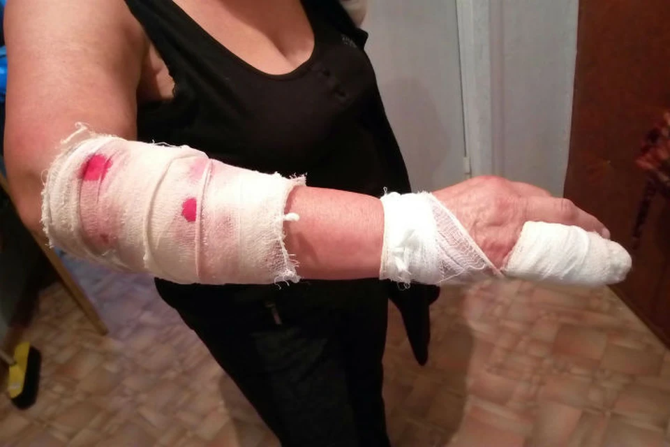 На ярославну на улице напала агрессивная овчарка. Фото: предоставлено семьей пострадавшей женщины.