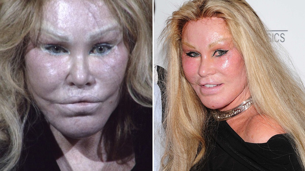 Angela rummans plastic surgery