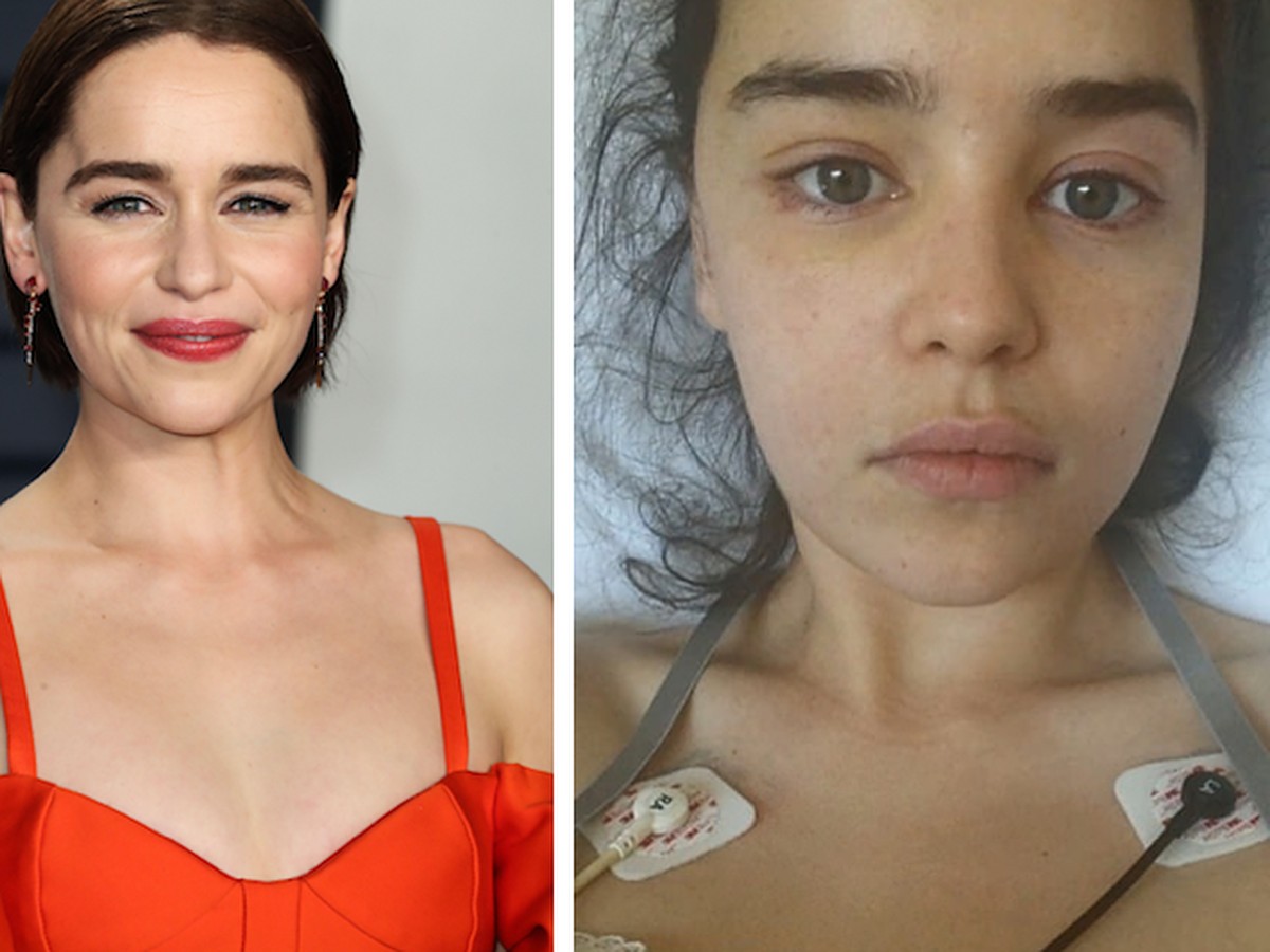 Звезда «Игры престолов» Эмилия Кларк поделилась снимками, сделанными после  инсульта и операции на мозге - KP.RU