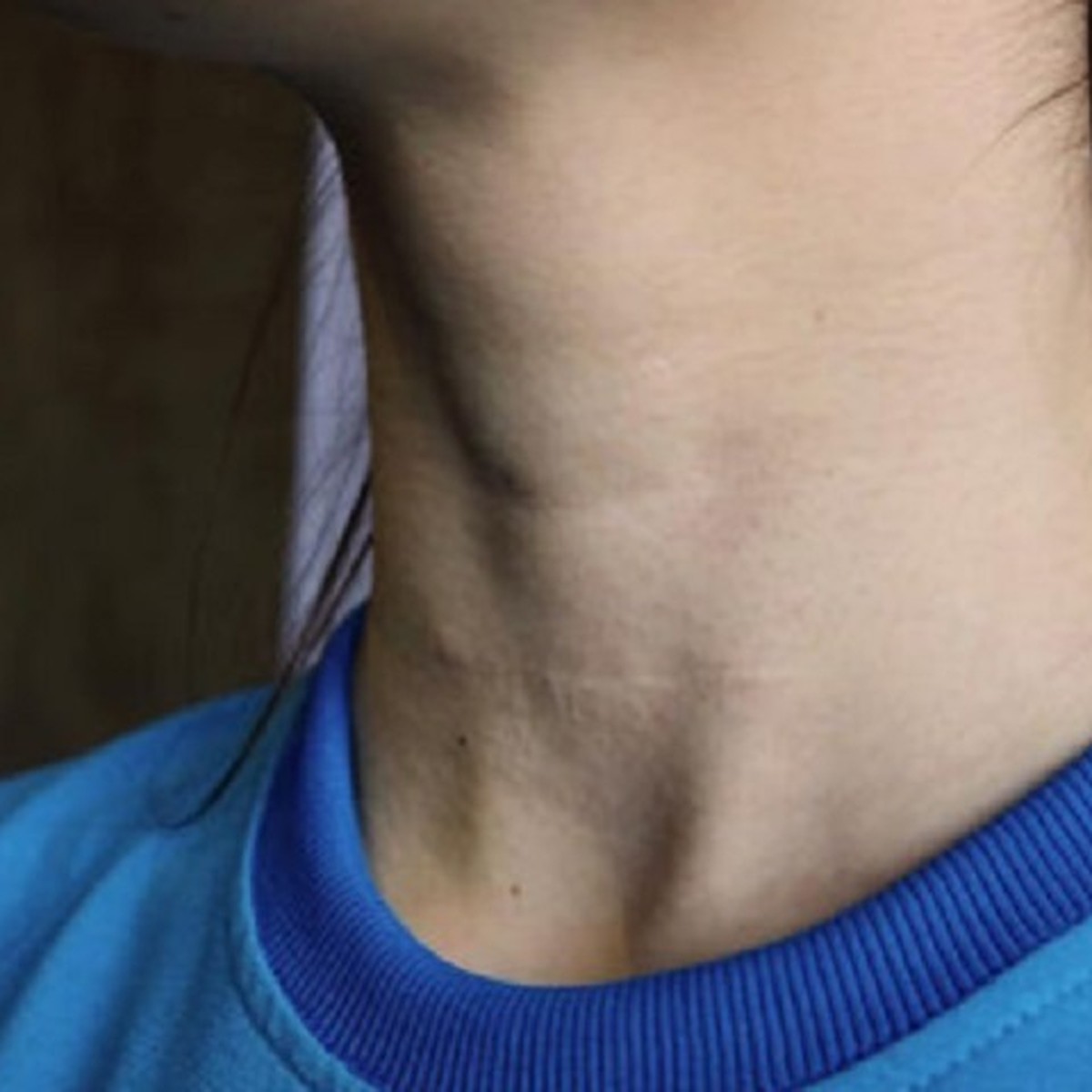 Рак щитовидной железы фото - GPTpedia.ru