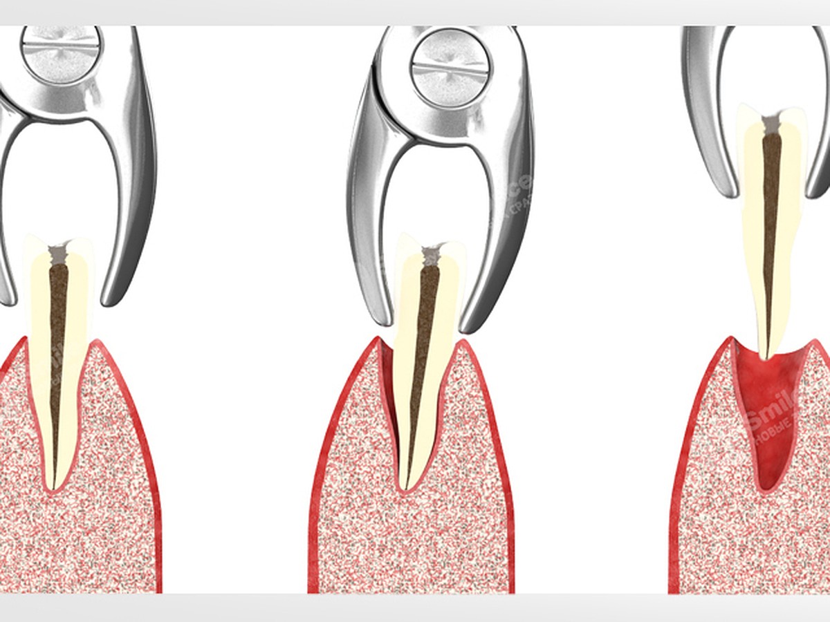 Процесс заживления лунки от зуба