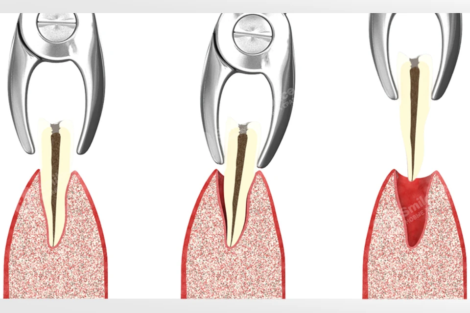 Как проходит процесс удаления зуба. Фото: Smile-at-Once