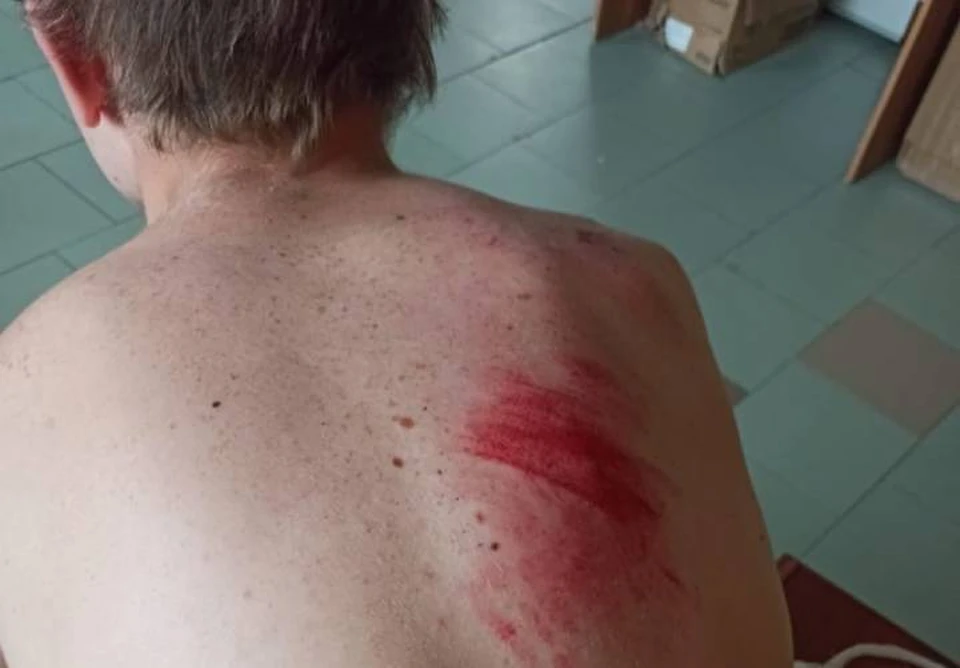 Особенно сильно пострадала спина одного из подростков. Фото: группа в "ВКонтакте" "Ростов Главный — новости Ростова-на-Дону"
