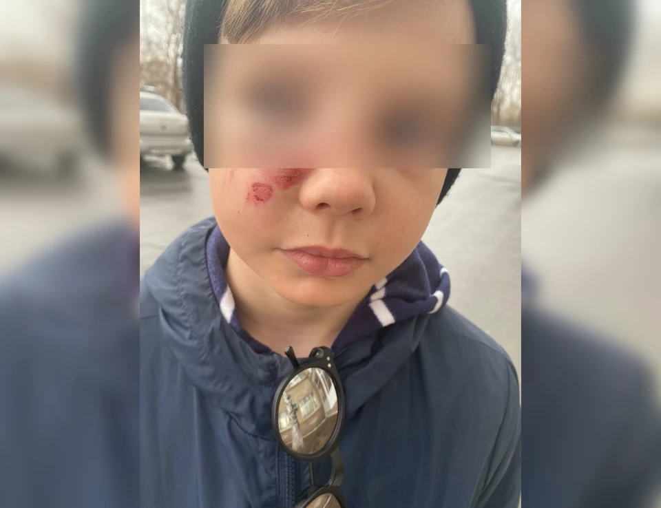 У мальчика многочисленные синяки на лице и теле, сломан нос