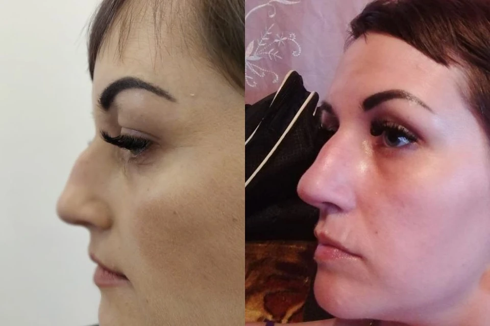По словам Елены, нос стал шире. Фото до операции - слева, после - справа. Фото: предоставлено Еленой Зуевич