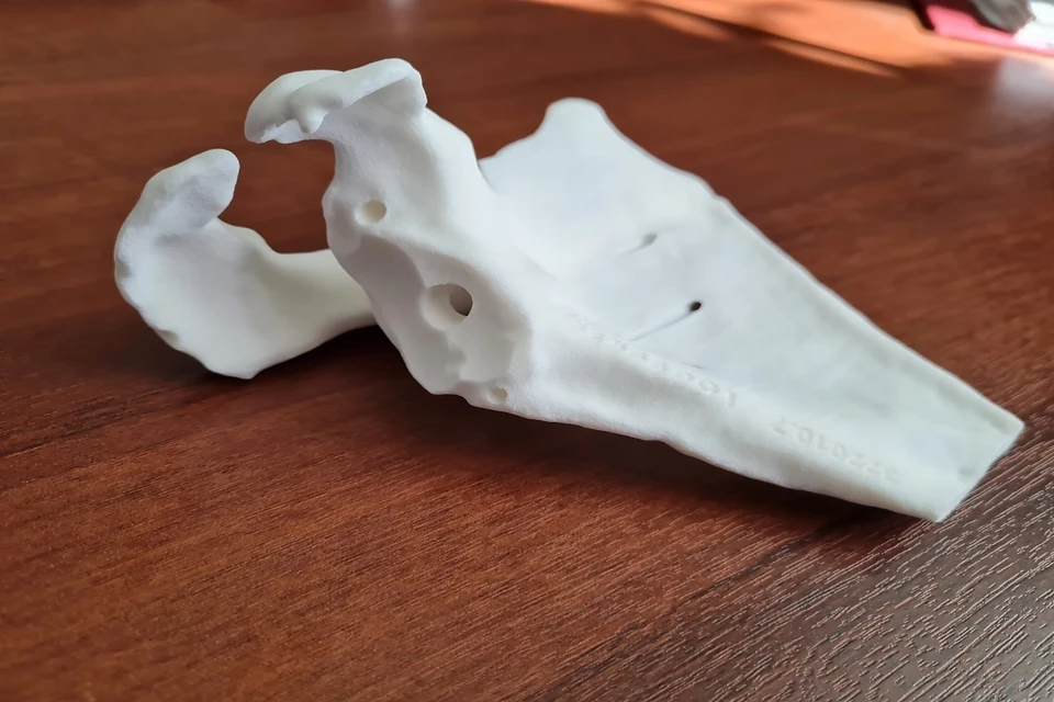 Новосибирские хирурги установили пенсионерке с разрушенным суставом 3D-имплант. Фото: пресс-служба НИИТО.