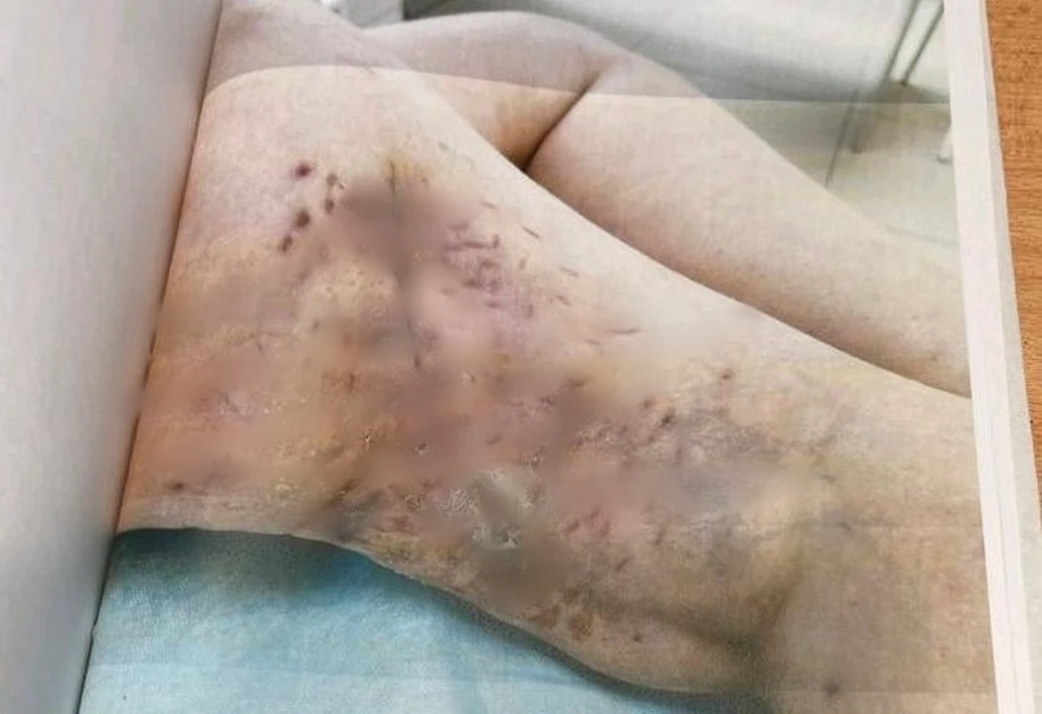 В Тюменской области огромный алабай нанес страшные раны женщине-соседке.