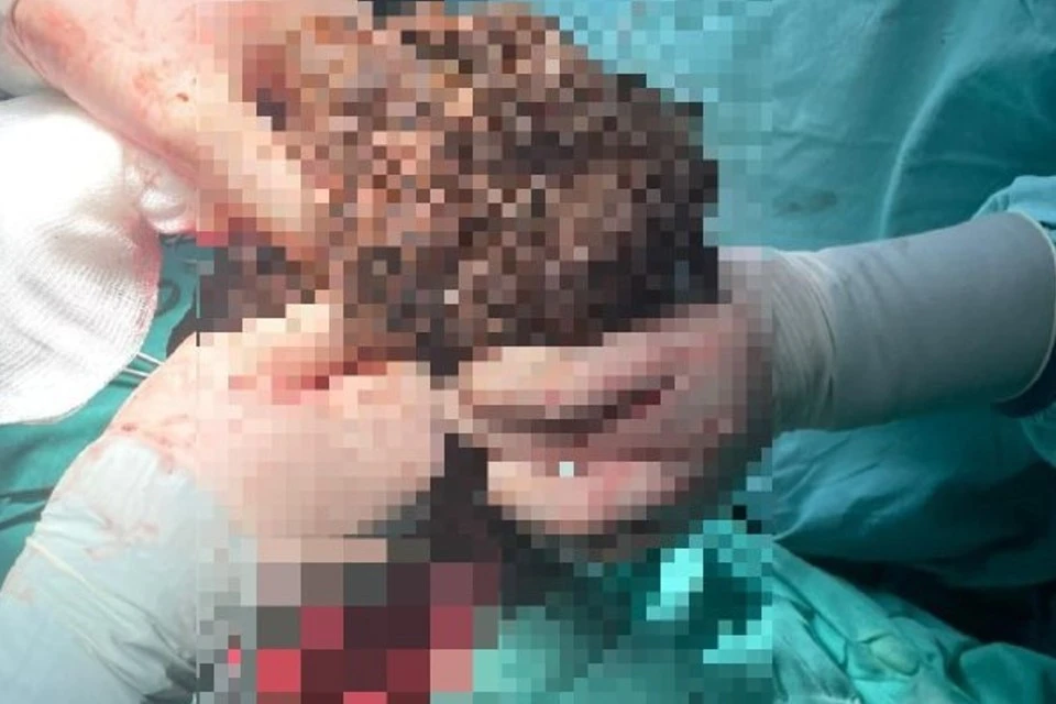 Врачи из подмосковного Щёлкова удалили из желудка 21-летней девушки три килограмма волос