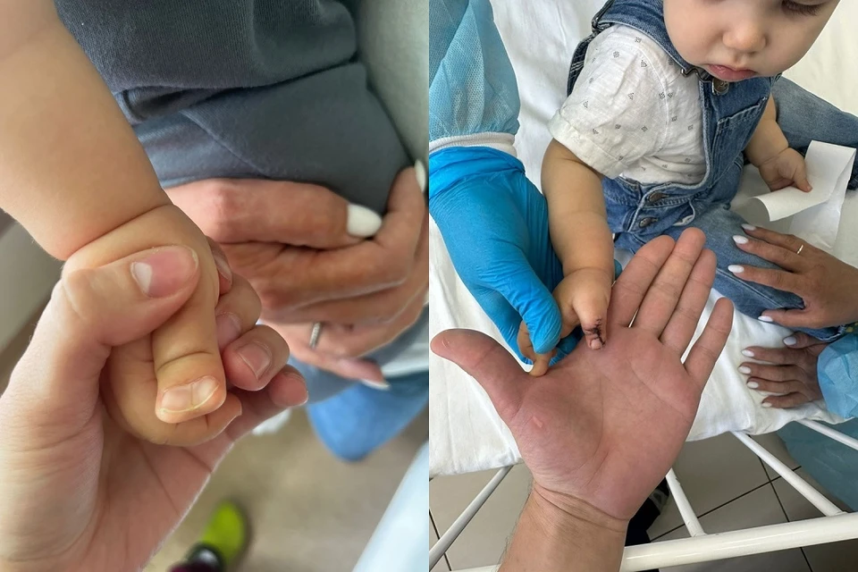 Новосибирские хирурги прооперировали годовалого мальчика с аномально большим пальцем. Фото: ННИИТО.