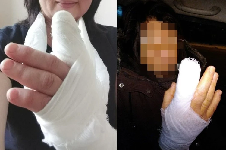 «Врачи сказали – разгрызла сустав, как собака»: в Новосибирске невестка перегрызла свекрови палец из-за замечания