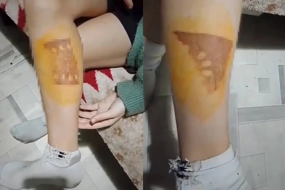 13-летнюю школьницу мучили с помощью раскаленного утюга. Фото: личный архив.