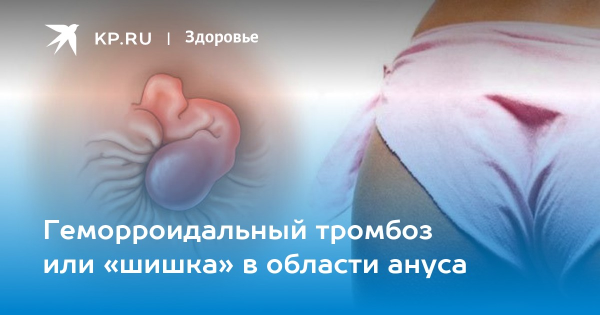 Шишки в заднем проходе – диагностика и лечение в Москве – «Алан Клиник»