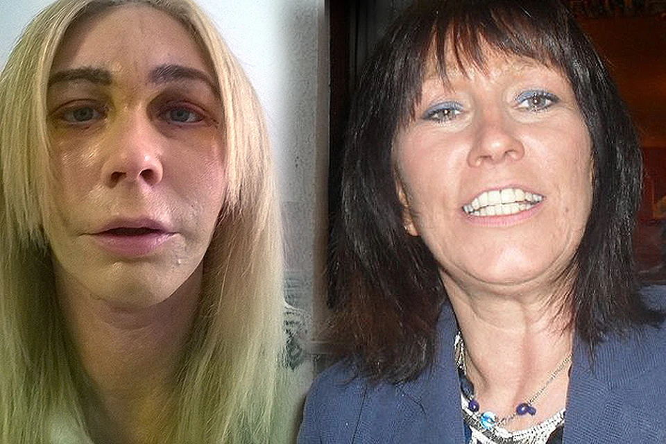 49-летняя Андреа Далцелл после до операции (справа) и сразу после (слева). Фото: FACEBOOK Andrea Dalcell