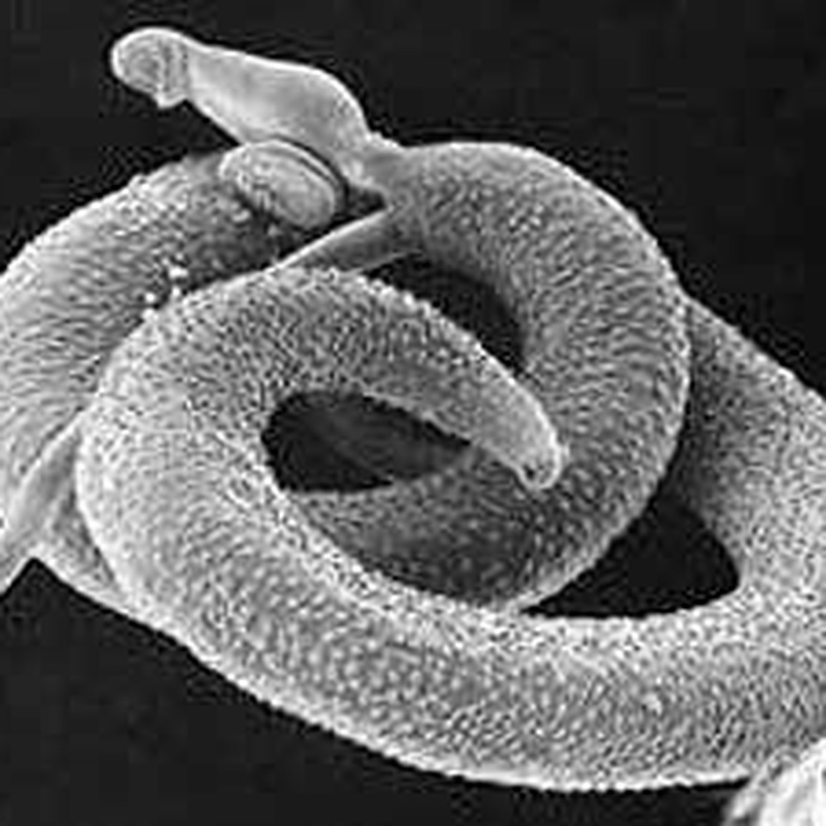 parazita schistosomiasis