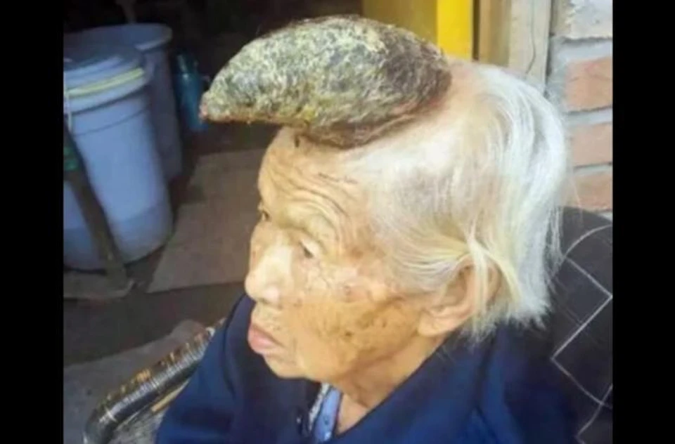 У 87-летней женщины образовалась доброкачественная опухоль в виде рога. Фото: youtube.com
