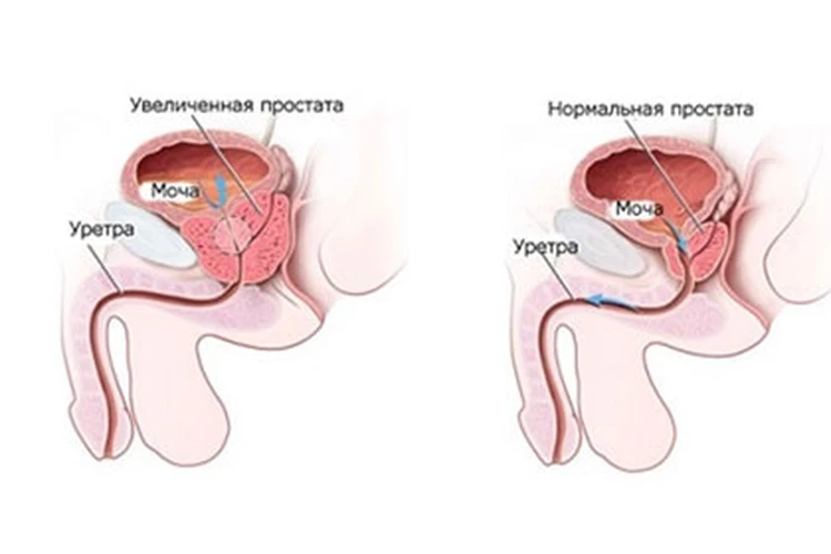 Народные средства от простатита и аденомы простаты