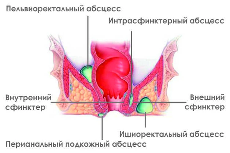 Парапроктит: лечение и диагностика причин, симптомов в Москве в ФНКЦ